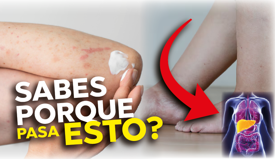 Imagen de Higado graso